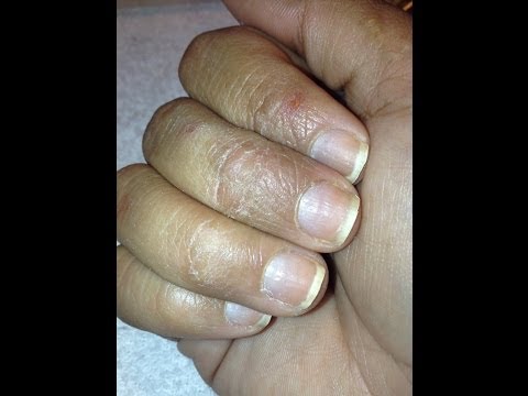 Cura di omeopatia di eczema di spazzole Se è possibile trattare laceto di psoriasi