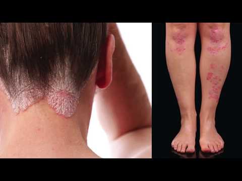 UVB Light Treatment for Psoriasis (before and after) - My Story