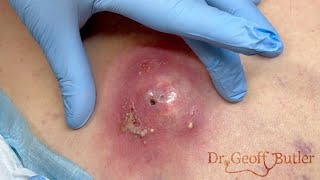 Drainage of a large infected epidermal cyst - Happy Easter!