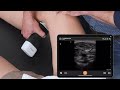 Deep Vein Thrombosis DVT Ultrasound Scanning Technique