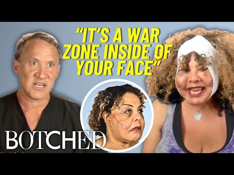 Botched OG Rajee Returns for a Third Time to Remove MORE Facial Lumps | Botched | E!