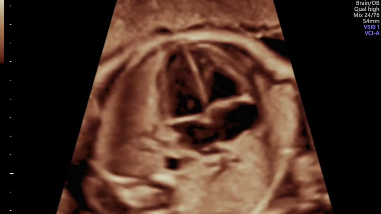 ECOGRAFIA DO CORAÇÃO FETAL