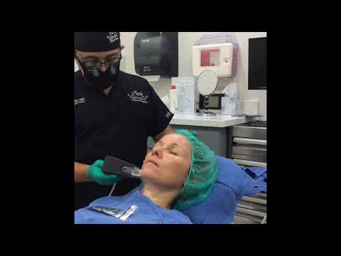 Overview
What Is Morpheus8 RF Microneedling?
Morpheus8 is an advanced microneedling device that delivers radiofrequency energy deep into the skin through a matrix of fine needles. The microneedling component creates controlled micro-injuries that trigger the body’s natural healing response and stimulate collagen production. The added radiofrequency energy amplifies this effect by further stimulating collagen and simultaneously contracting the underlying tissue for a tightening result that traditional microneedling alone cannot achieve.
The combination addresses both surface skin quality and deeper structural laxity in a single treatment session.