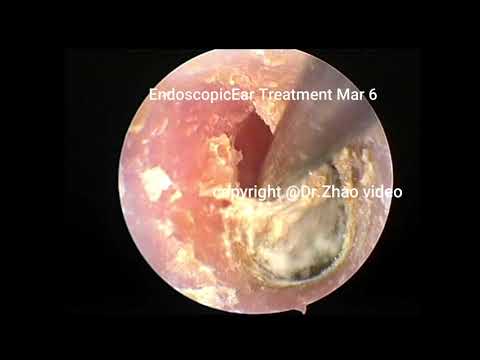 Ear wax removal extration,External auditory canal...
