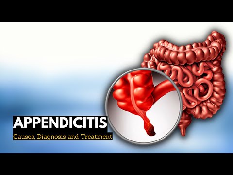Appendicitis, Causes, Signs and Symptoms, Diagnosis and Treatment.