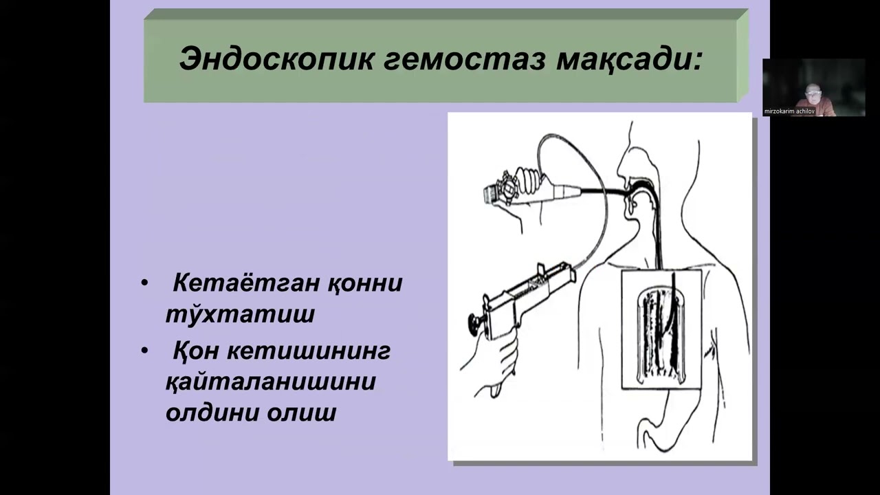 Meda va o'n ikki barmoqli ichak yara kasalligi asoratlari (qon ketish, pilorostenoz)