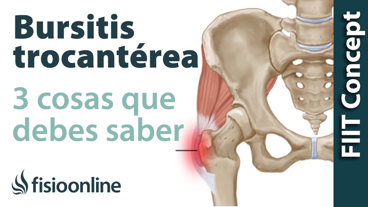 3 cosas que debes saber sobre la trocanteritis o bursitis trocantérea