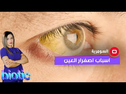 شاهد بالفيديو.. ما هي اسباب اصفرار العين؟