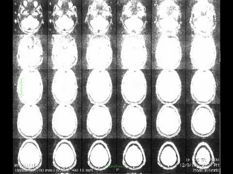 R2 Motion During ACS bg
