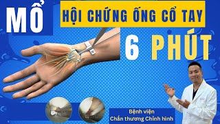Mổ hội chứng ống cổ tay 6 phút - Khớp Việt Official