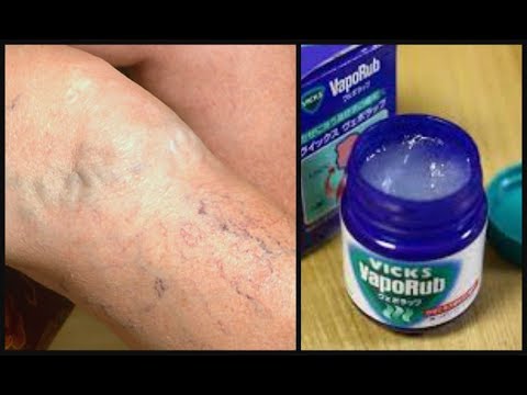 castane din venele varicoase i tromboflebita cum sa manânci în vene varicoase