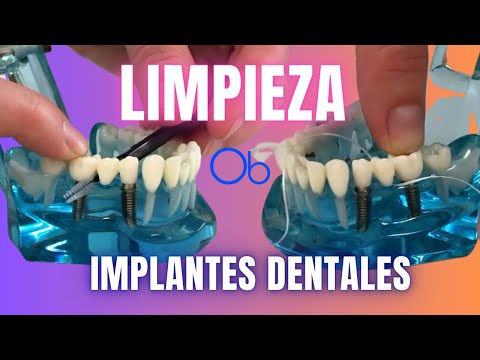 Limpieza de Implantes dentales