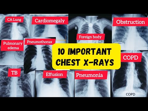 important chest xray #radiology #chest #pulmonology #neetpg #fmge #usmle