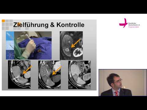 Die Preise in den Städten des Kniegelenkersatzes Warum ein wunder Hals, wenn das Virus