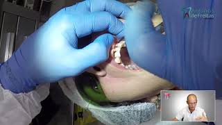 15-Extração de 8 dentes com adaptação de prótese total imediata. Dr: Antônio Sérgio F Freitas.