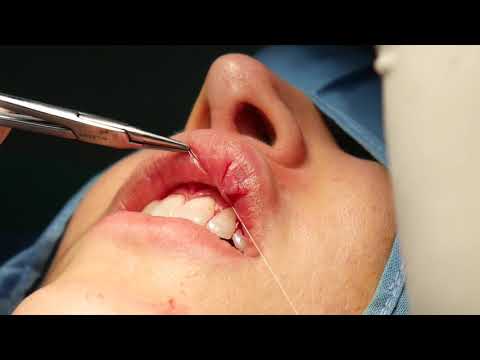 A Girl From London Gets Her Lips Fixed In Nagercoil - Facial Plastic Surgery