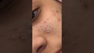😌Remove pimple in overnight permanently/Overnight Acne Treatment #ytshorts #viralvedios #acneremoval