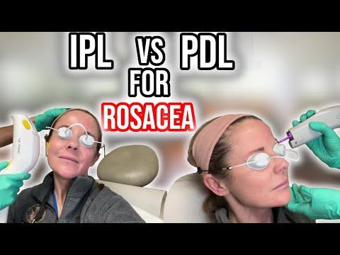 PDL vs IPL for Rosacea: Dermatologist guide