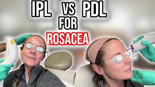 PDL vs IPL for Rosacea: Dermatologist guide
