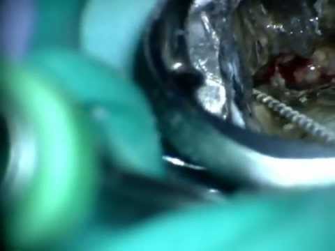 歯学科 歯根破折を顕微鏡で確認