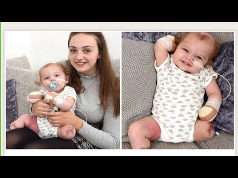 Elle raconte comment son bébé a perdu ses jambres et ses bras à cause d'une infection mortelle Video