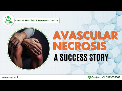 Stem Cell Therapy for Avascular Necrosis (AVN) in India | Patient Testimonial | Bioscience Solutions