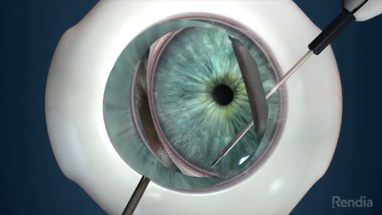 Auckland Eye iStent Infinite Sx Animation for Patient Recruitment 2022