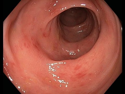 Behandlung der Volksheilmittel für die Behandlung von Prostatitis Zuverlässige Methoden für die Behandlung von Prostatitis