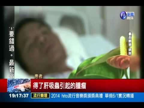 生吃淡水魚 肝吸蟲下肚致病變