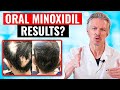 20 000 PEOPLE TOOK ORAL MINOXIDIL AND THIS HAPPENED
