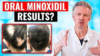 20,000 PEOPLE TOOK ORAL MINOXIDIL AND THIS HAPPENED