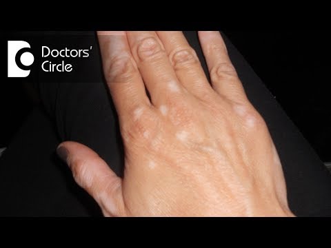 Can white spots in skin be fungal infection? - Dr. Madhu SM