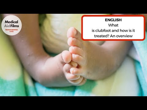 What is clubfoot and how is it treated?  An overview