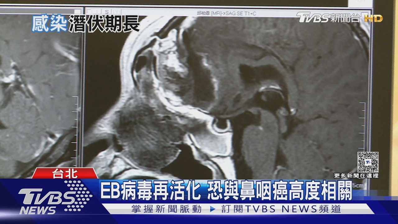 EB病毒感染！恐增鼻咽癌風險　醫：單側耳悶.頸部腫塊.鼻血是警訊