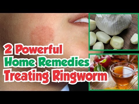 2 Powerful Home Remedies For Treating Ringworm