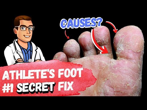 , title : 'BEST Athlete's Foot Fungus Treatments [HOME Remedies + 3 BIG SECRETS]'