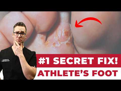 BEST Athlete's Foot Fungus Treatments [HOME Remedies + 3 BIG SECRETS]