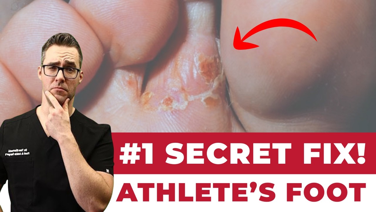 BEST Athlete's Foot Fungus Treatments [HOME Remedies + 3 BIG SECRETS]