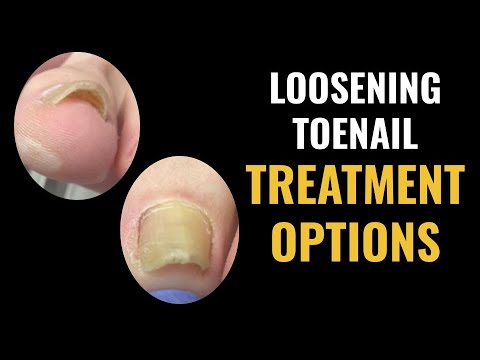 Kung paano gamutin ang kuko para sa isang linggo Kung paano mapupuksa ang halamang-singaw sa toenails