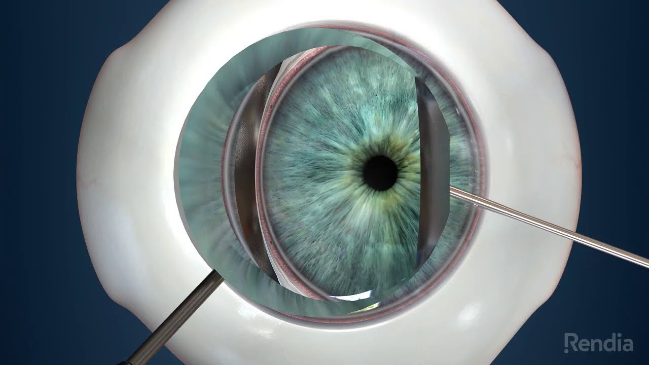 iStent inject W Animation