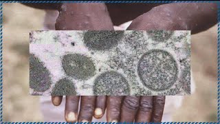Minnesota reports its first presumptive case of monkeypox
