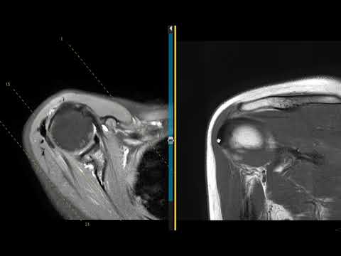 Calcific tendinitis of shoulder in 44 year old female