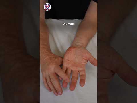 Simple Techniques for Healthy Hands - Dupuytren's contracture