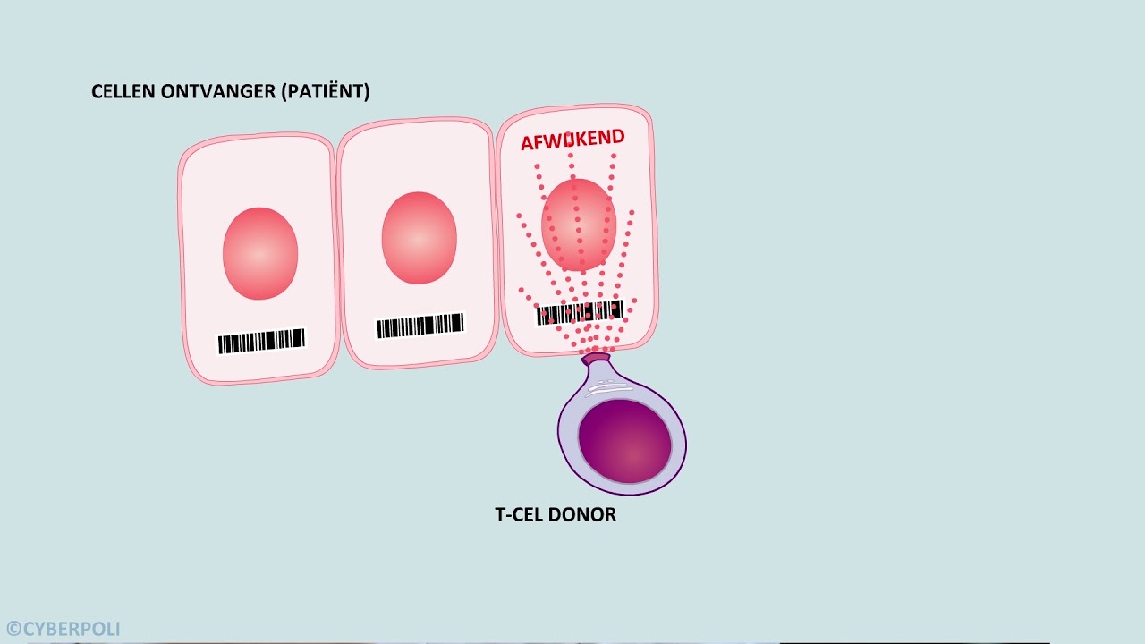 Sikkelcelziekte - Stamceltransplantatie Is Nu Nog De Enig… | Cyberpoli