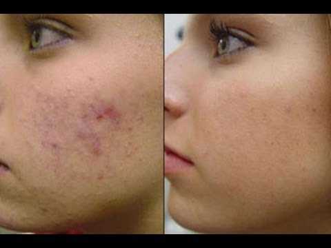 Come candeggiare la pelle di faccia e togliere la pigmentazione La crema per candeggiare di pelle di mani