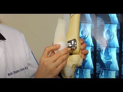 Image - Surgery for Patellofemoral Arthritis