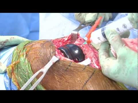 Exparel Use in Total Knee Arthroplasty 