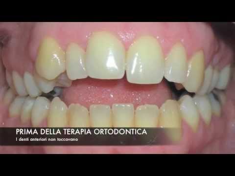 Quando mangiare troppo mal di schiena Massaggio al miele prezzo osteocondrosi