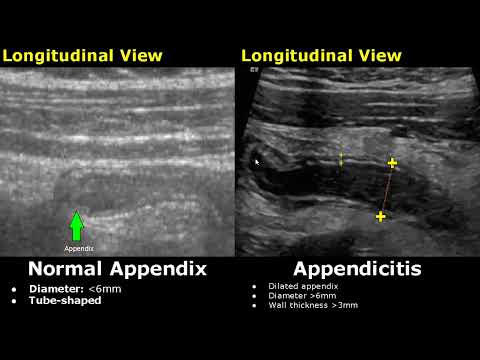 Appendix Ultrasound Normal Vs Abnormal Image Appearances | Appendicitis USG Scan