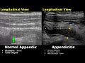 Appendix Ultrasound Normal Vs Abnormal Image Appearances | Appendicitis USG Scan